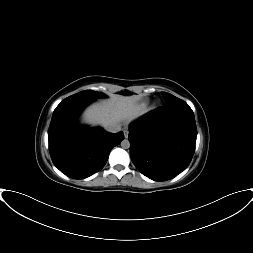 Caroli disease with medullary sponge kidney (Radiopaedia 82622-96804 Axial non-contrast 11).jpg