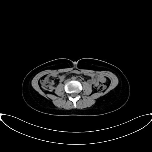 Caroli disease with medullary sponge kidney (Radiopaedia 82622-96804 Axial non-contrast 42).jpg