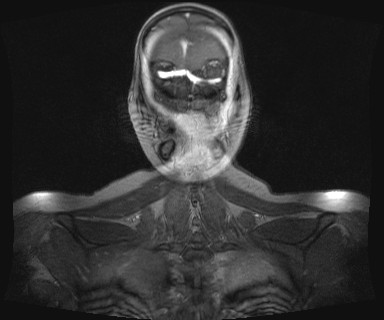 Carotid body tumor (Radiopaedia 12777-12912 MRA 79).jpg