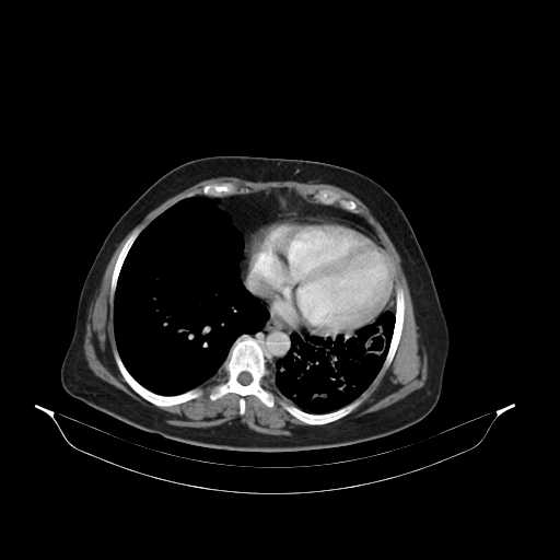 File:Carotid body tumor (Radiopaedia 21021-20948 B 49).jpg
