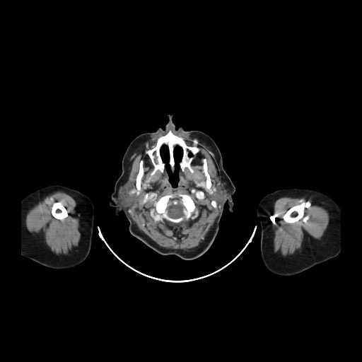 File:Carotid body tumor (Radiopaedia 21021-20948 B 6).jpg