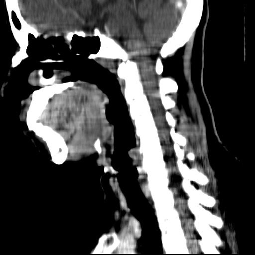 File:Carotid body tumor (Radiopaedia 27890-28124 C 11).jpg