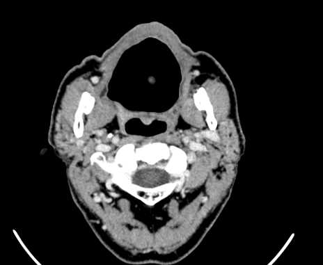 Carotid body tumor (Radiopaedia 61750-69757 Axial Post contrast 16).jpg