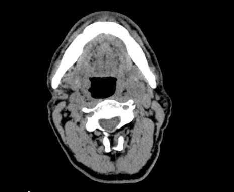 File:Carotid body tumor (Radiopaedia 61750-69757 Axial non-contrast 38).jpg