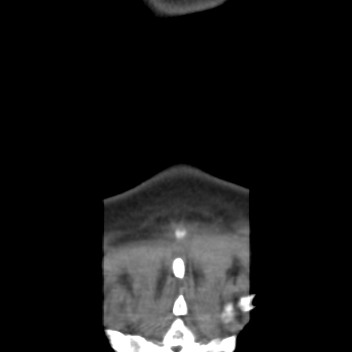 File:Carotid body tumor (paraganglioma) (Radiopaedia 38586-40729 B 42).jpg
