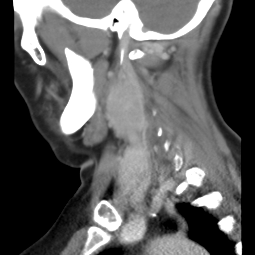 File:Carotid body tumor (paraganglioma) (Radiopaedia 38586-40729 C 21).jpg