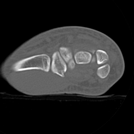 File:Carpo-metacarpal fracture-dislocations with hamatum split fracture (Radiopaedia 18482-18343 Axial bone window 22).jpg