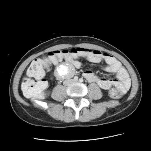 Castleman disease with fibrous pseudotumor in the abdomen (Radiopaedia 77296-89373 A 72).jpg