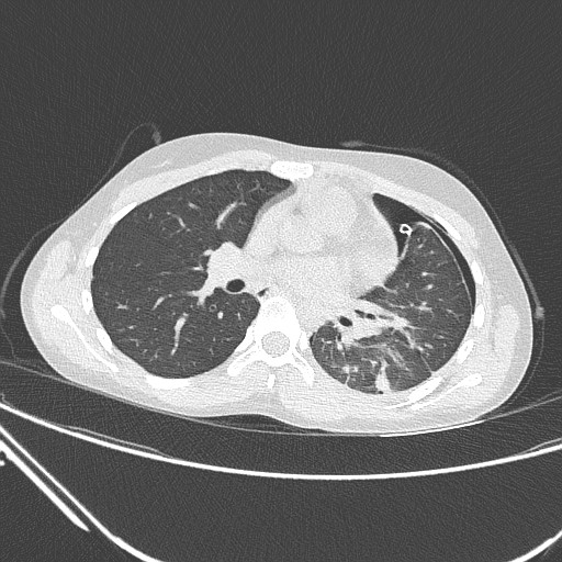 Catamenial pneumothorax (Radiopaedia 27946-28197 lung window 81).jpg