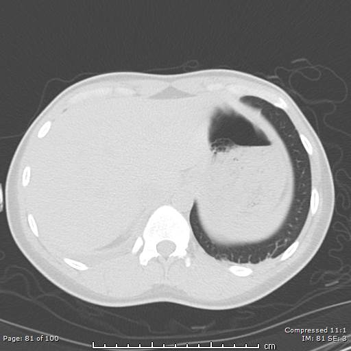 File:Catamenial pneumothorax (Radiopaedia 54382-60600 Axial non-contrast 81).jpg