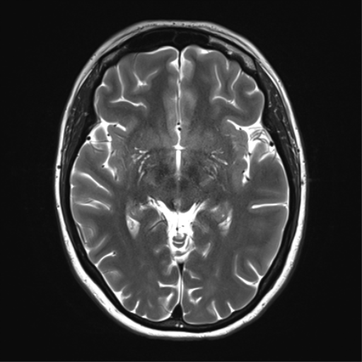 File:Cavernoma with bleed - midbrain (Radiopaedia 54546-60773 Axial T2 18).png