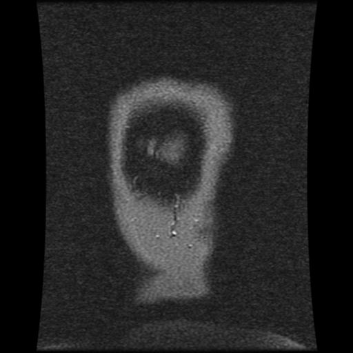 Cavernoma with developmental venous anomaly (Radiopaedia 22470-22507 MRV 22).jpg
