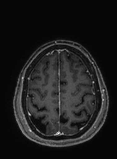 Cavernous hemangioma of the cerebellar falx (Radiopaedia 73025-83724 Axial T1 C+ 74).jpg