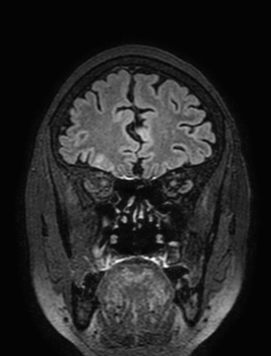 Cavernous hemangioma of the cerebellar falx (Radiopaedia 73025-83724 Coronal FLAIR 78).jpg