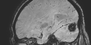 Cavernous hemangioma of the cerebellar falx (Radiopaedia 73025-83724 Sagittal BOLD 63).jpg