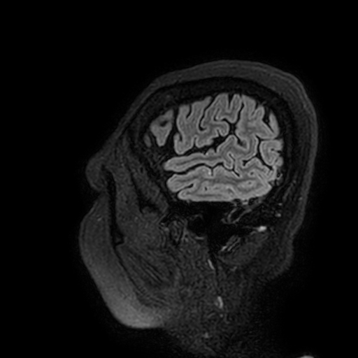 Cavernous hemangioma of the cerebellar falx (Radiopaedia 73025-83724 Sagittal FLAIR 199).jpg
