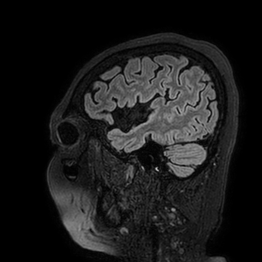 File:Cavernous hemangioma of the cerebellar falx (Radiopaedia 73025-83724 Sagittal FLAIR 33).jpg