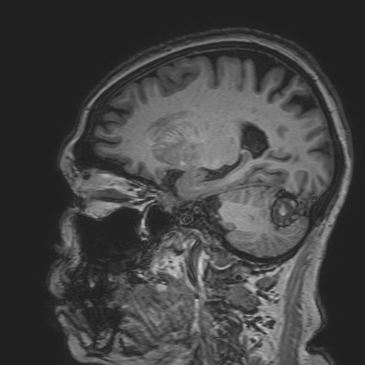 File:Cavernous hemangioma of the cerebellar falx (Radiopaedia 73025-83724 Sagittal T1 77).jpg