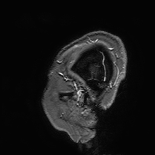 File:Cavernous hemangioma of the cerebellar falx (Radiopaedia 73025-83724 Sagittal T1 C+ 10).jpg