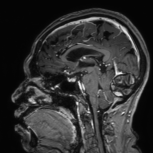 Cavernous hemangioma of the cerebellar falx (Radiopaedia 73025-83724 Sagittal T1 C+ 111).jpg
