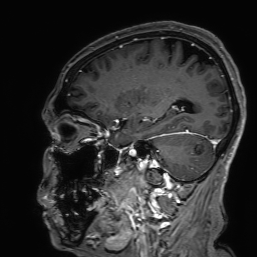 Cavernous hemangioma of the cerebellar falx (Radiopaedia 73025-83724 Sagittal T1 C+ 68).jpg