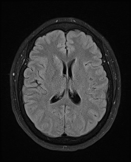 File:Cavernous sinus meningioma (Radiopaedia 63682-72367 Axial FLAIR 14).jpg