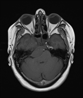 File:Cavernous sinus meningioma (Radiopaedia 63682-72367 Axial T1 7).jpg