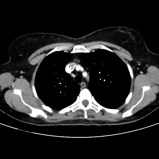 File:Cavitating lung mass - squamous cell carcinoma (Radiopaedia 48047-52854 B 14).png