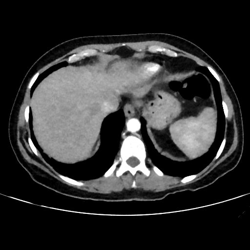 File:Cavitating lung mass - squamous cell carcinoma (Radiopaedia 48047-52854 B 39).png