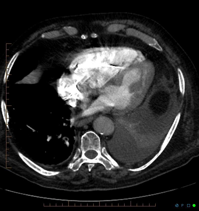 Cavitating pulmonary infarction (Radiopaedia 54634-60849 Axial C+ CTPA 60).jpg