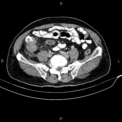 Cecal cancer with appendiceal mucocele (Radiopaedia 91080-108651 B 74).jpg
