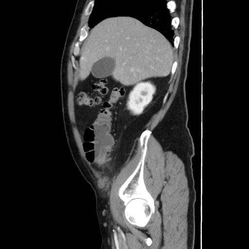 Cecal mass causing appendicitis (Radiopaedia 59207-66531 C 13).jpg