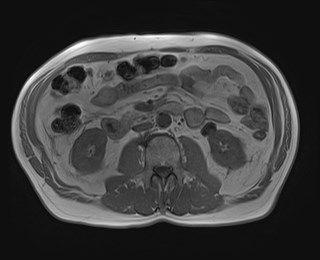 File:Cecal mass causing appendicitis (Radiopaedia 59207-66532 Axial T1 in-phase 68).jpg