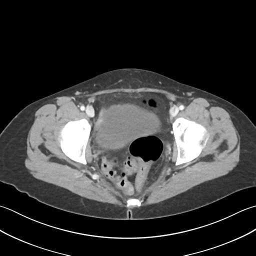 File:Cecum hernia through the foramen of Winslow (Radiopaedia 46634-51112 A 67).png