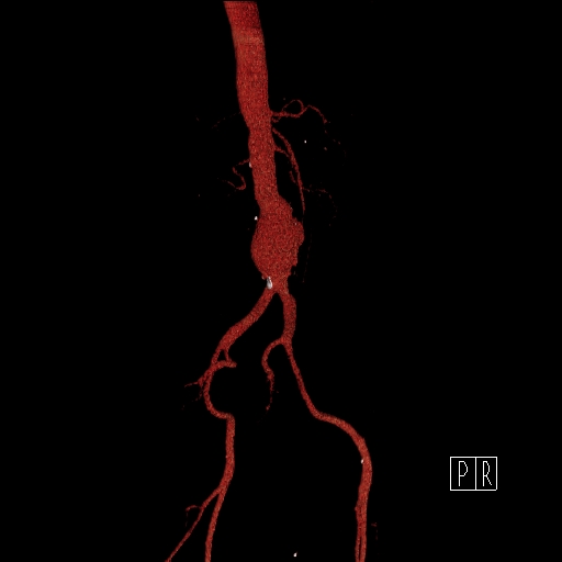 File:Celiac artery compression by the diaphragmatic crurae (Radiopaedia 31739-32666 3D CTA 8).jpg