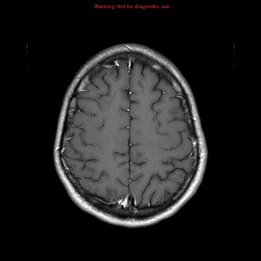 File:Central nervous system vasculitis (Radiopaedia 8410-9235 Axial T1 C+ 19).jpg