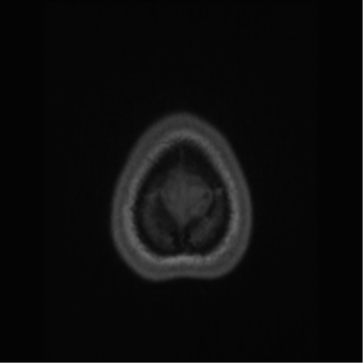 File:Central neurocytoma (Radiopaedia 37664-39557 Axial T1 71).png