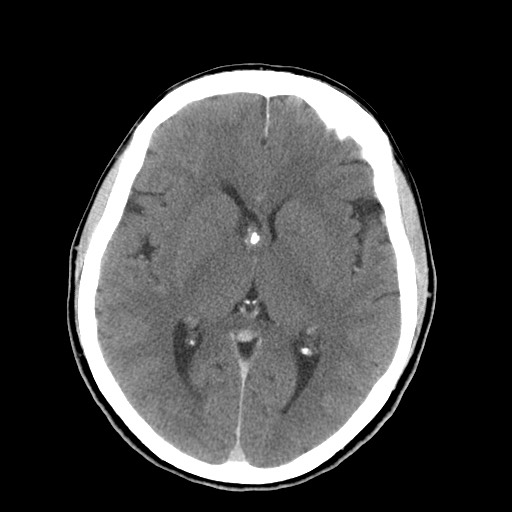 Central neurocytoma (Radiopaedia 68725-78432 Axial C+ 39).jpg