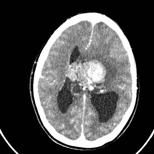 Central neurocytoma (Radiopaedia 84497-99871 B 28).jpg