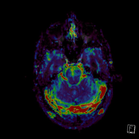 Central neurocytoma (Radiopaedia 84497-99872 Axial Perfusion 235).jpg