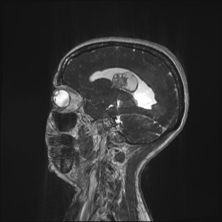 File:Central neurocytoma (Radiopaedia 84497-99872 Sagittal CISS 14).jpg