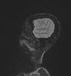 Central neurocytoma (Radiopaedia 84497-99872 Sagittal Flair + Gd 25).jpg