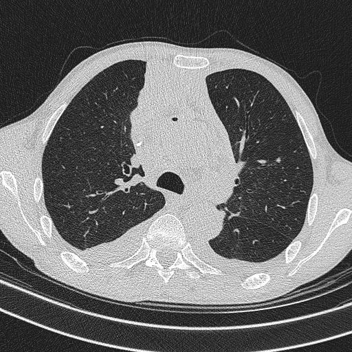 Central venous catheter tip extravasation (Radiopaedia 82828-97113 Axial lung window 34).jpg