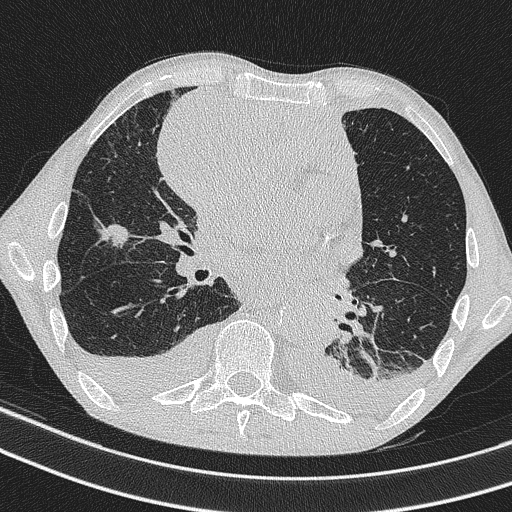 Central venous catheter tip extravasation (Radiopaedia 82828-97113 Axial lung window 49).jpg