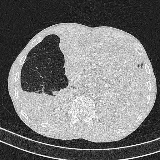 Central venous catheter tip extravasation (Radiopaedia 82828-97113 Axial lung window 70).jpg