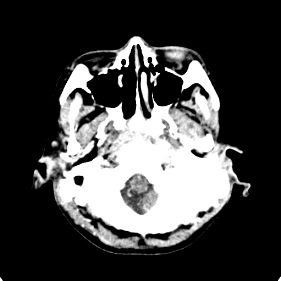 Cerebellar abscess secondary to mastoiditis (Radiopaedia 26284-26412 Axial C+ delayed 14).jpg