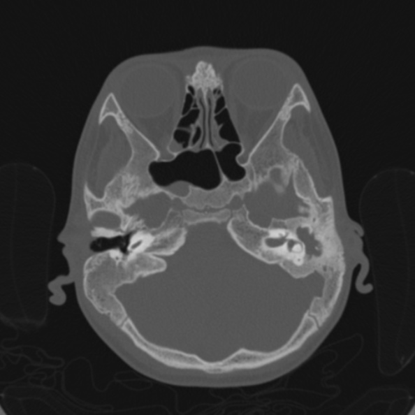 Cerebellar abscess secondary to mastoiditis (Radiopaedia 26284-26413 Axial bone window 50).jpg