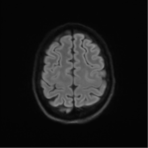 Cerebellar agenesis with hypoplastic pons (pontocerebellar hypoplasia) (Radiopaedia 57224-64138 Axial DWI 67).png