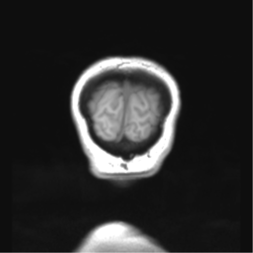 Cerebellar ependymoma complicated by post-operative subdural hematoma (Radiopaedia 83322-97736 Coronal T1 56).png