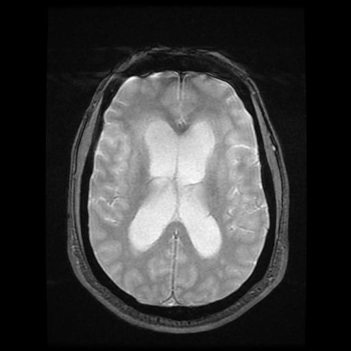 File:Cerebellar hemangioblastoma (Radiopaedia 88055-104622 Axial Gradient Echo 12).jpg